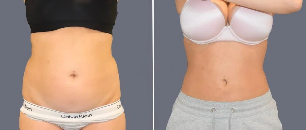tummy vaser female pre2024 038 before and after before and after