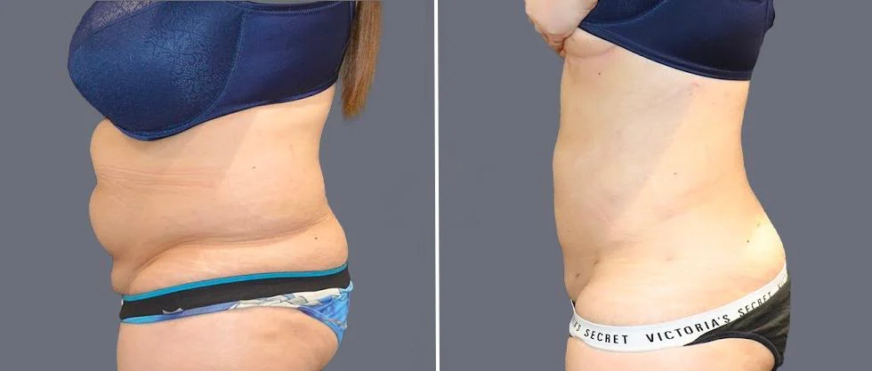 tummy vaser female pre2024 041 before and after before and after