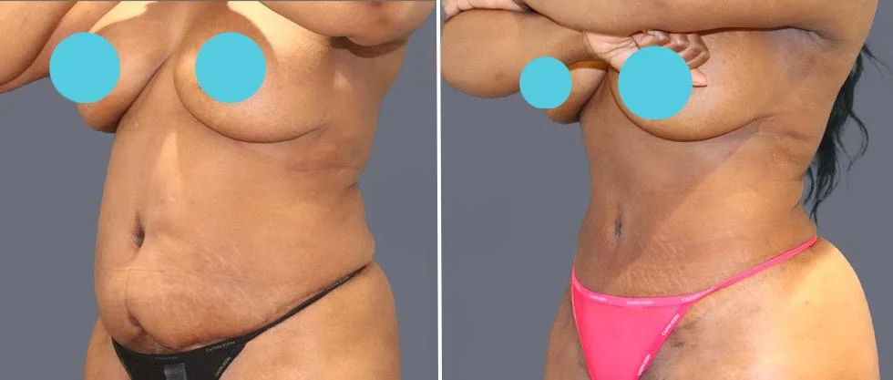 tummy vaser female pre2024 042 before and after before and after