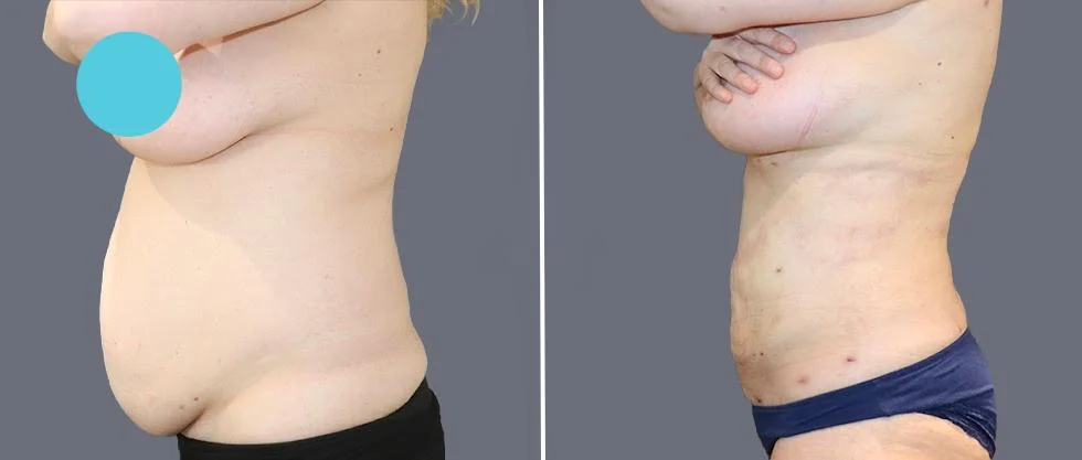 tummy vaser female pre2024 045 before and after before and after
