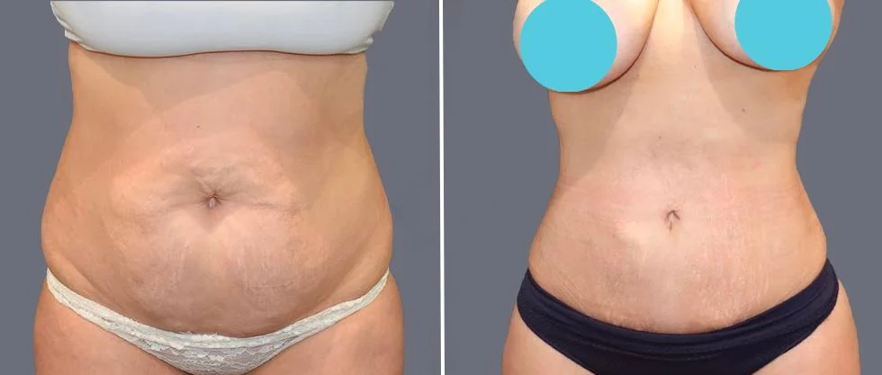 tummy vaser female pre2024 048 before and after before and after