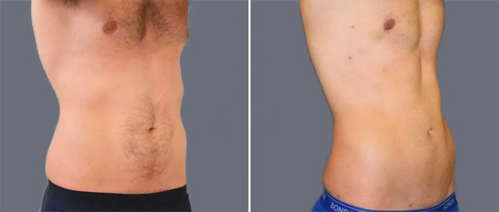 tummy vaser male pre2024 002 before and after before and after