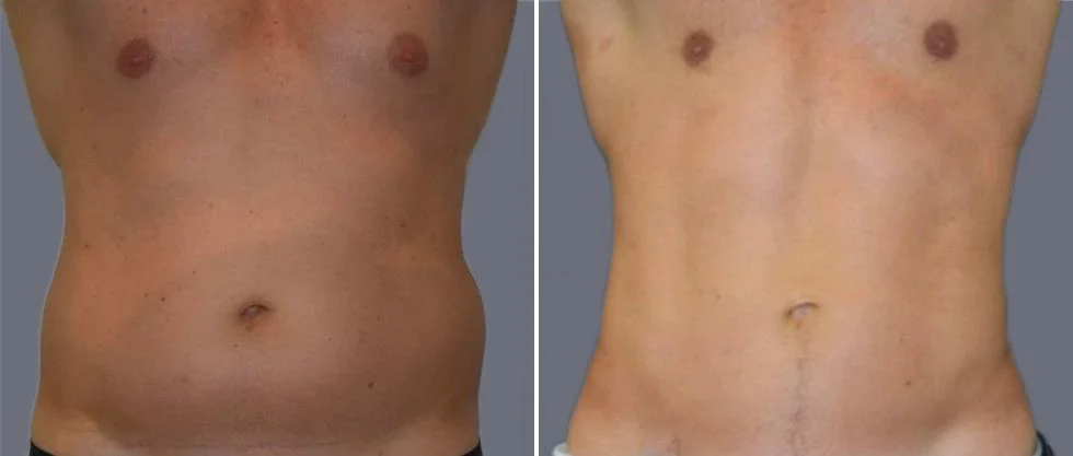tummy vaser male pre2024 005 before and after before and after