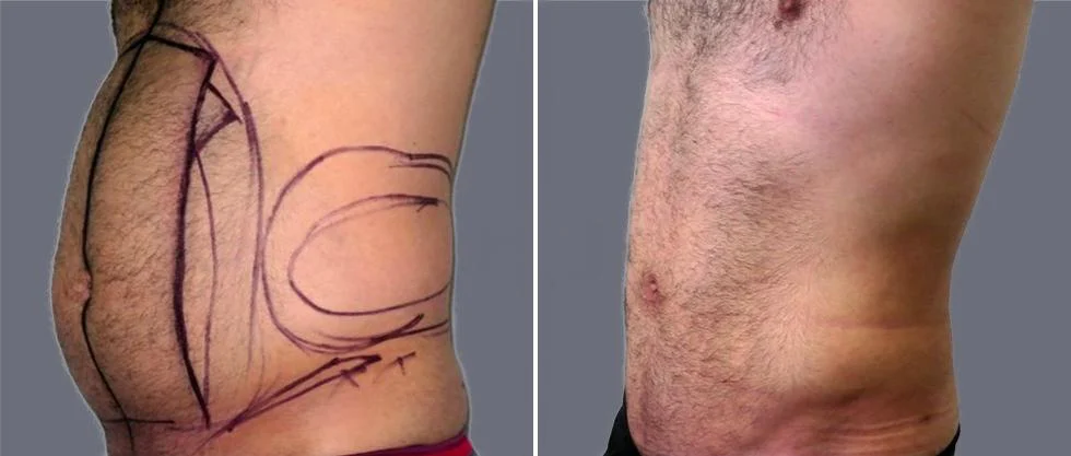 tummy vaser male pre2024 006 before and after before and after