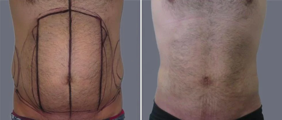tummy vaser male pre2024 008 before and after before and after