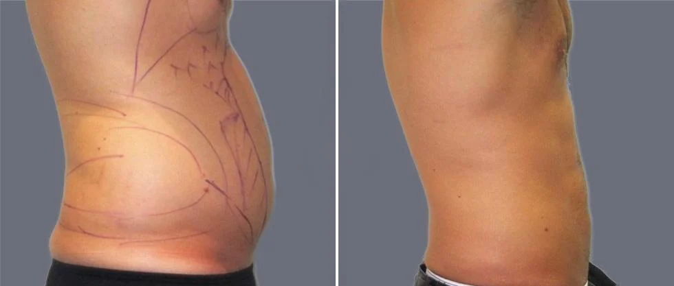 tummy vaser male pre2024 009 before and after before and after