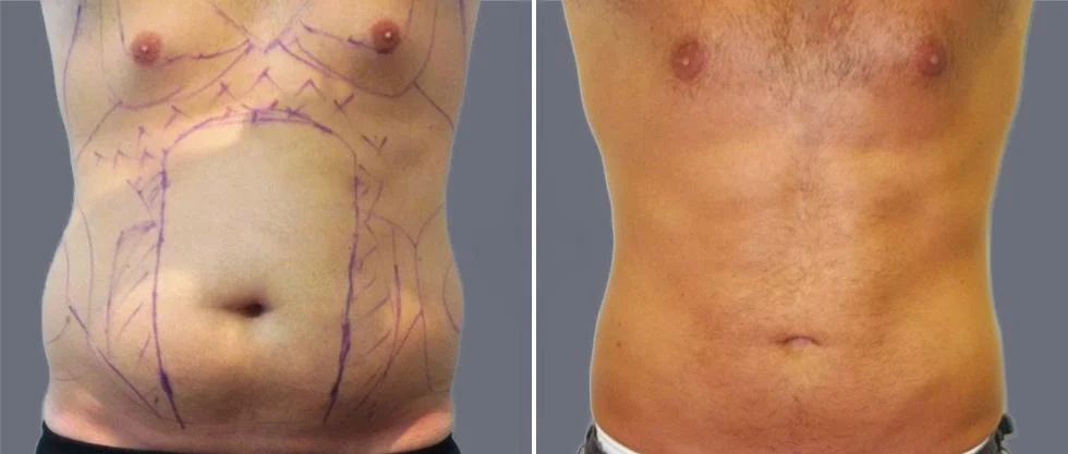 tummy vaser male pre2024 010 before and after before and after