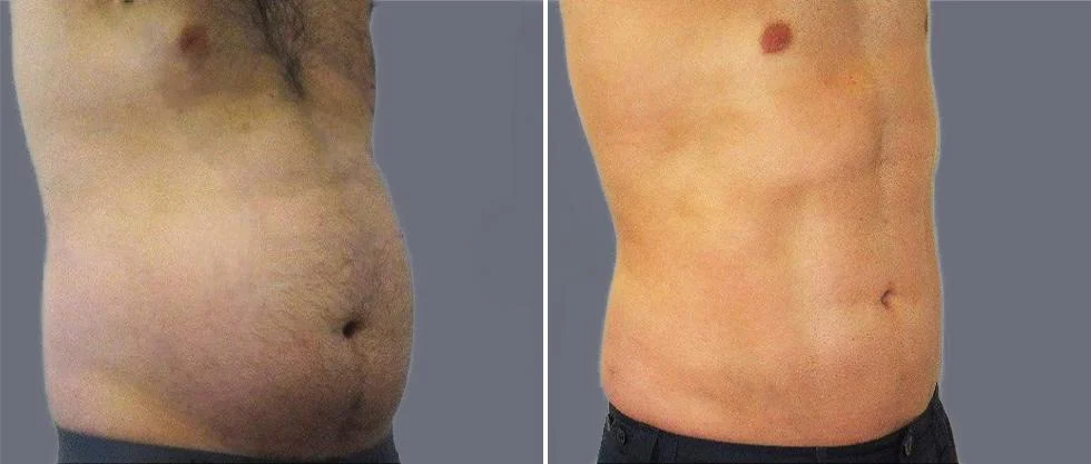 tummy vaser male pre2024 011 before and after before and after