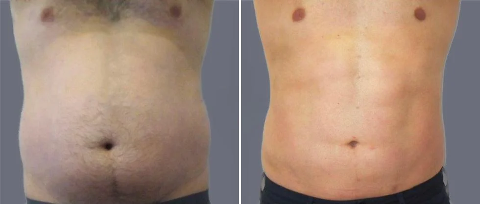 tummy vaser male pre2024 012 before and after before and after