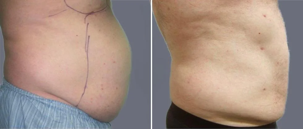 tummy vaser male pre2024 013 before and after before and after