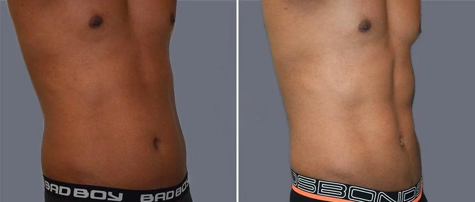 tummy vaser male pre2024 015 before and after before and after