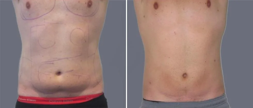 tummy vaser male pre2024 016 before and after before and after