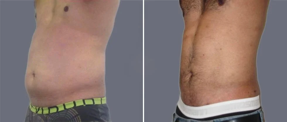 tummy vaser male pre2024 017 before and after before and after