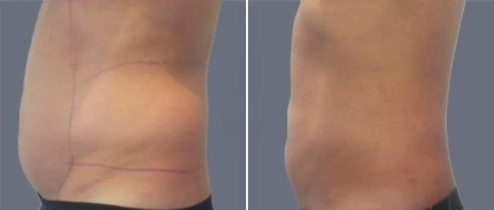 tummy vaser male pre2024 018 before and after before and after