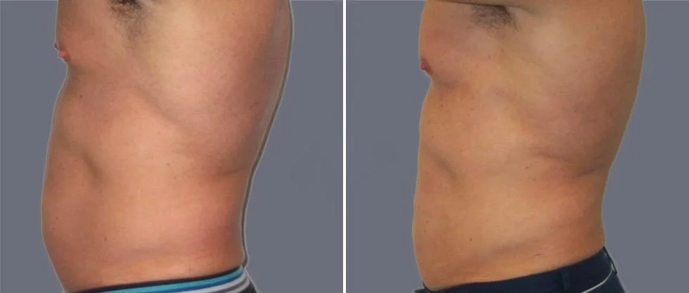 tummy vaser male pre2024 019 before and after before and after