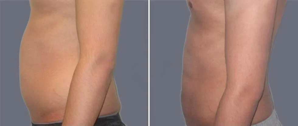 tummy vaser male pre2024 020 before and after before and after