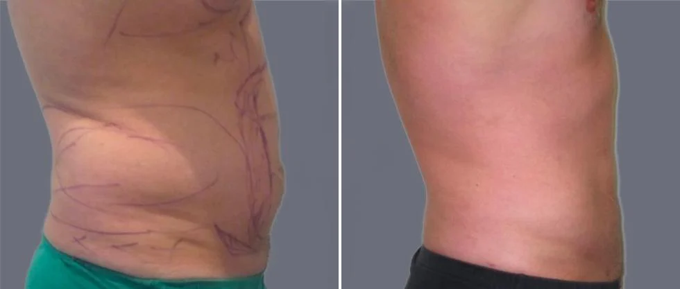 tummy vaser male pre2024 022 before and after before and after