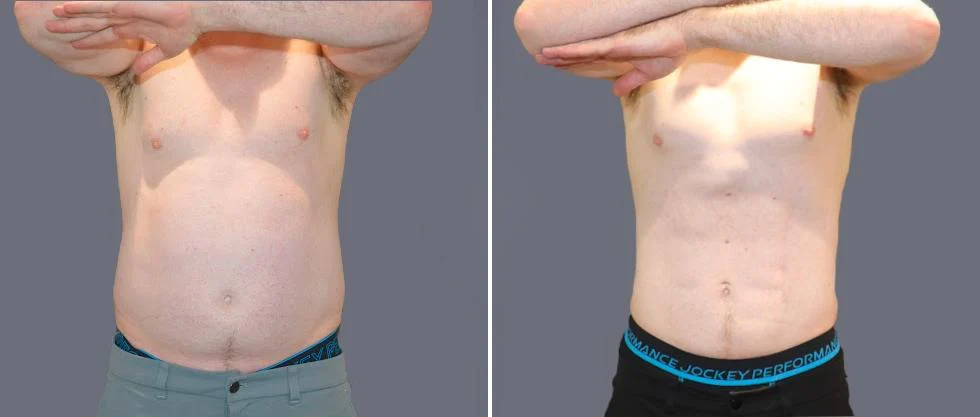 tummy vaser male pre2024 023 before and after before and after