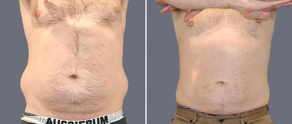 tummy vaser male pre2024 024 before and after before and after