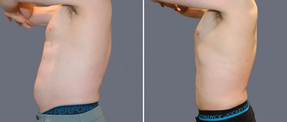 tummy vaser male pre2024 028 before and after before and after