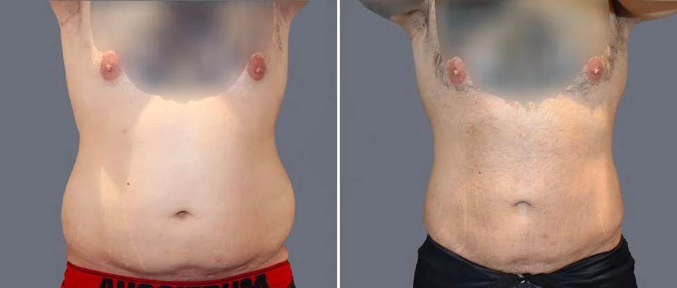 tummy vaser male pre2024 030 before and after before and after