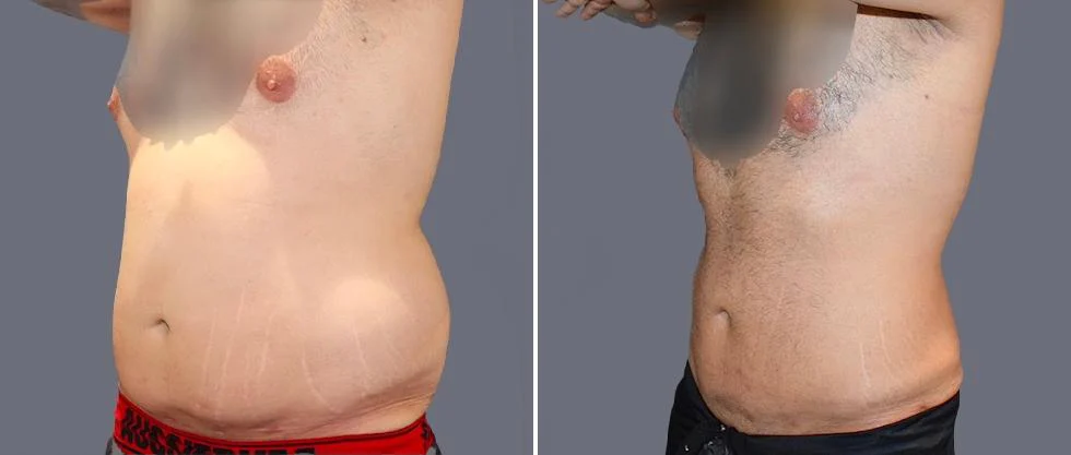 tummy vaser male pre2024 031 before and after before and after