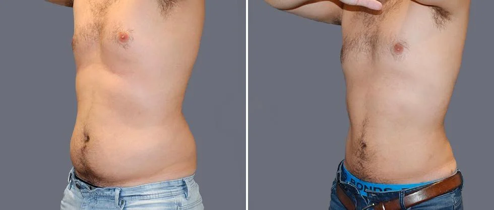 tummy vaser male pre2024 033 before and after before and after
