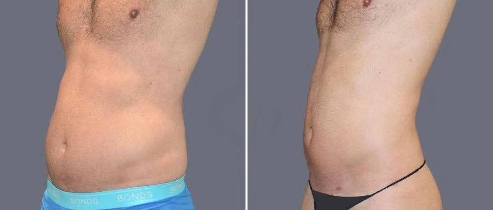 tummy vaser male pre2024 035 before and after before and after