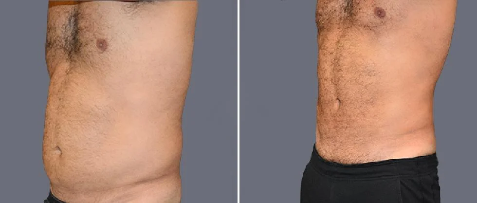 tummy vaser male pre2024 037 before and after before and after