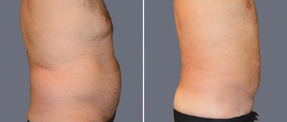 tummy vaser male pre2024 038 before and after before and after