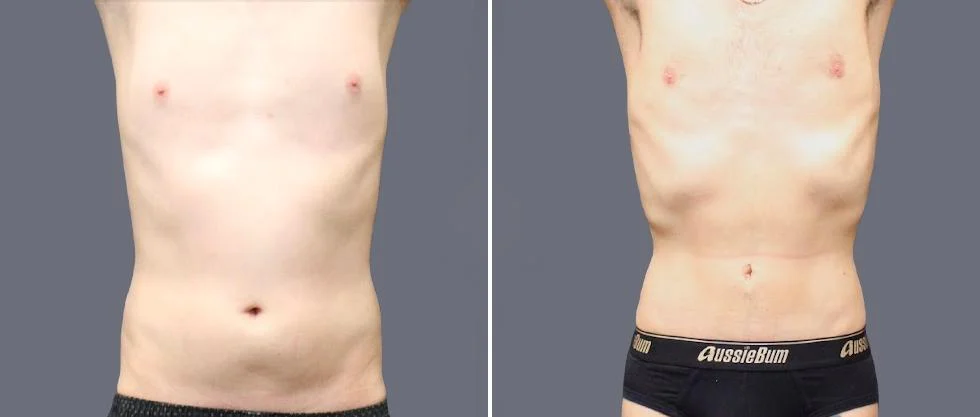 tummy vaser male pre2024 039 before and after before and after