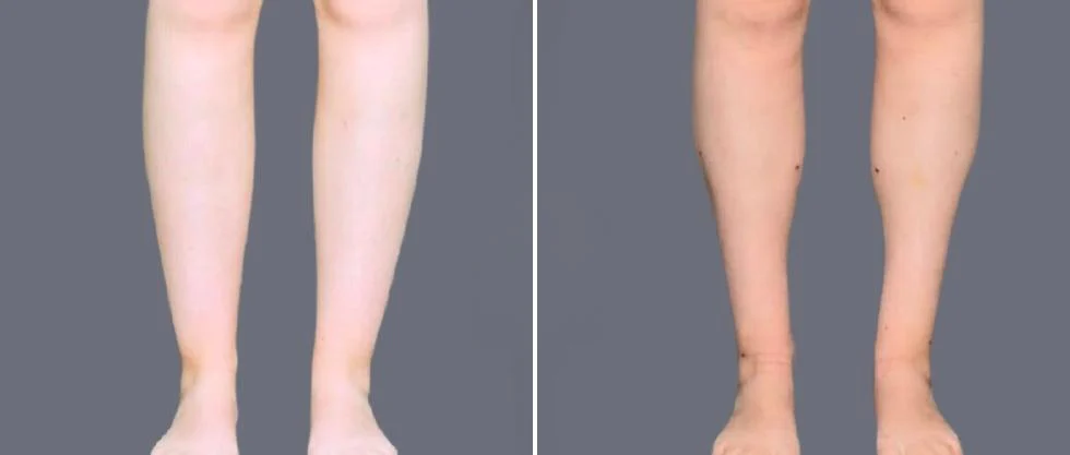 vaser ankleliposuction female pre2024 001 before and after before and after
