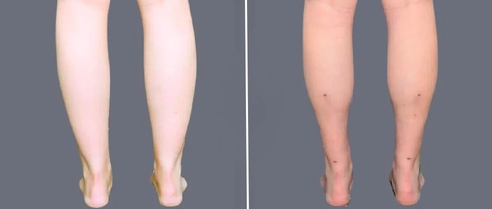 vaser ankleliposuction female pre2024 003 before and after before and after