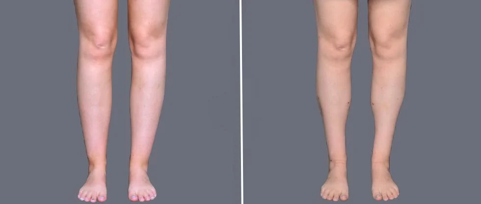 vaser ankleliposuction female pre2024 004 before and after before and after