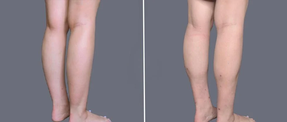 vaser ankleliposuction female pre2024 006 before and after before and after