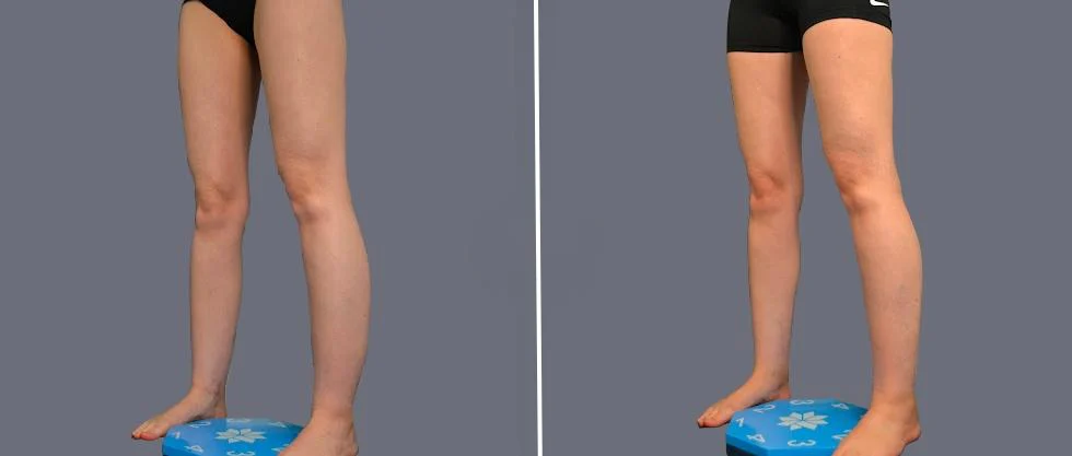 vaser ankleliposuction female pre2024 007 before and after before and after