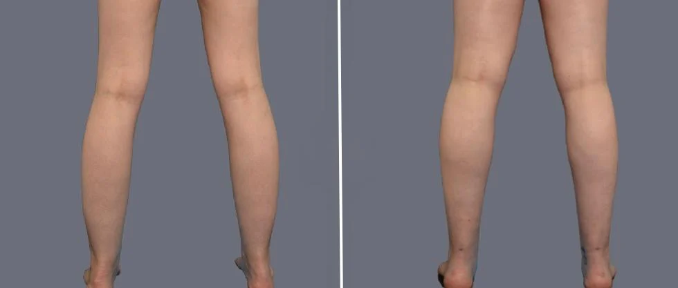 vaser ankleliposuction female pre2024 008 before and after before and after