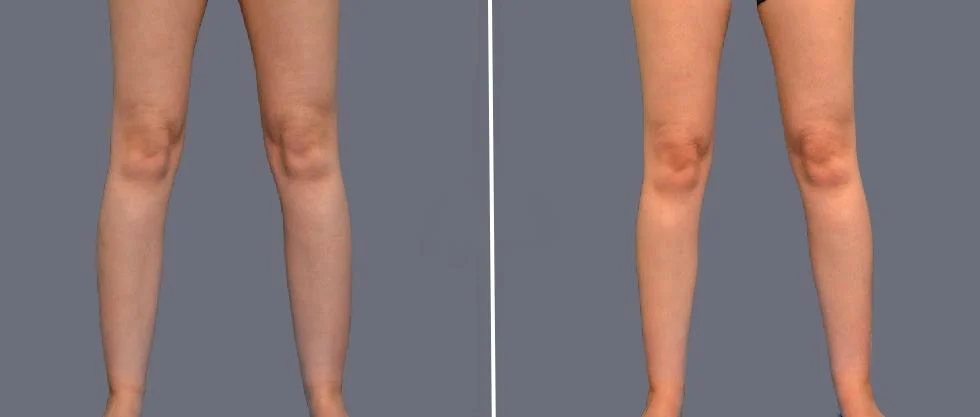 vaser ankleliposuction female pre2024 009 before and after before and after