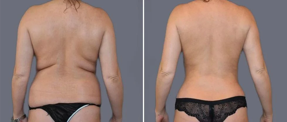 vaser back liposcution female pre2024 002 before and after before and after
