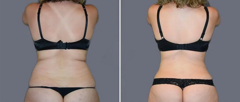 vaser back liposcution female pre2024 003 before and after before and after