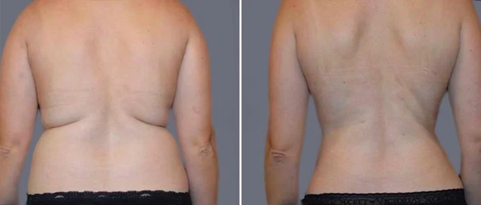 vaser back liposcution female pre2024 005 before and after before and after