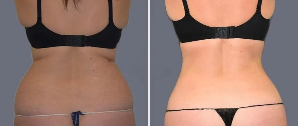 vaser back liposcution female pre2024 006 before and after before and after
