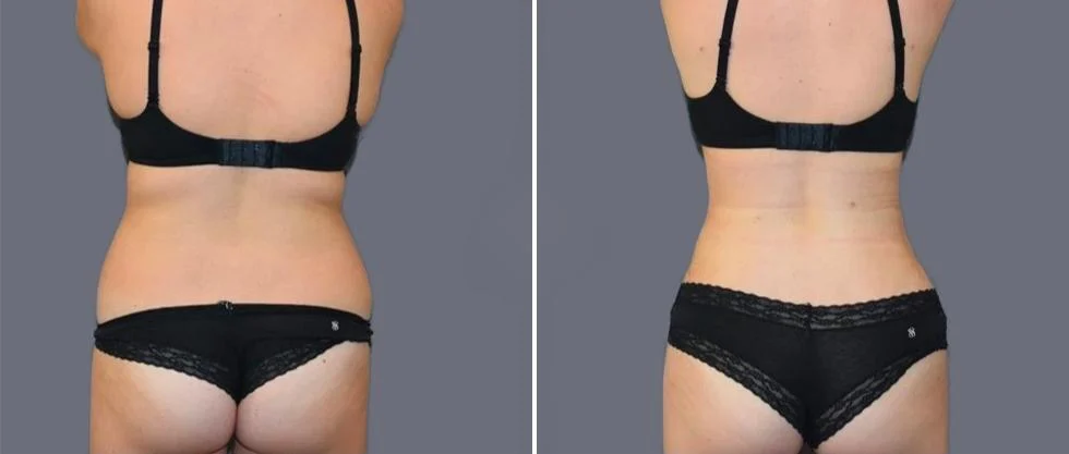 vaser back liposcution female pre2024 007 before and after before and after