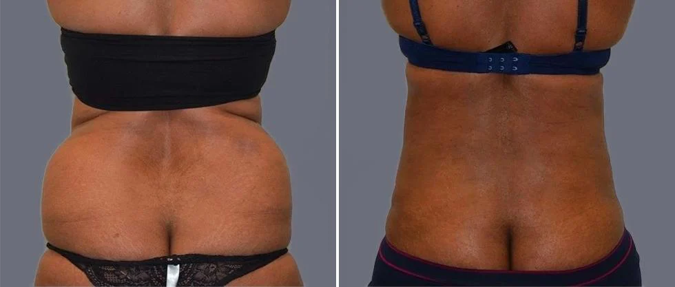 vaser back liposcution female pre2024 008 before and after before and after