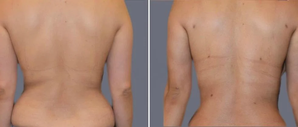 vaser back liposcution female pre2024 009 before and after before and after