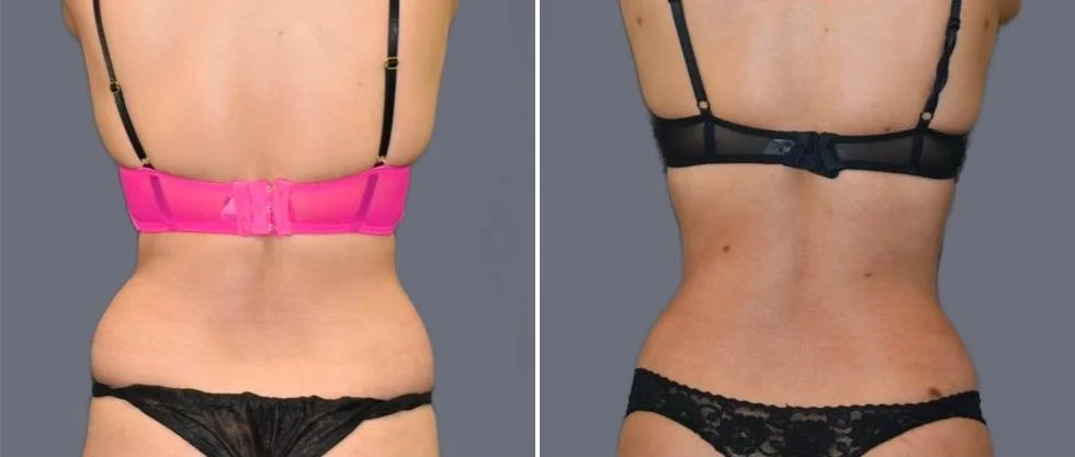 vaser back liposcution female pre2024 010 before and after before and after