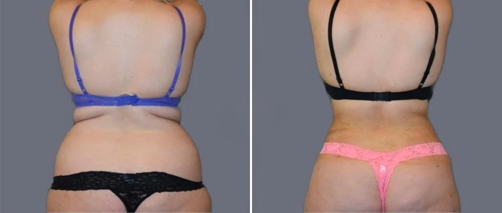 vaser back liposcution female pre2024 011 before and after before and after