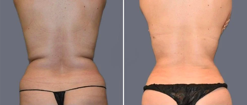 vaser back liposcution female pre2024 012 before and after before and after
