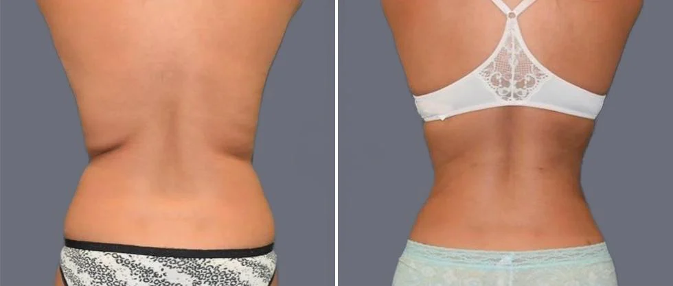 vaser back liposcution female pre2024 013 before and after before and after