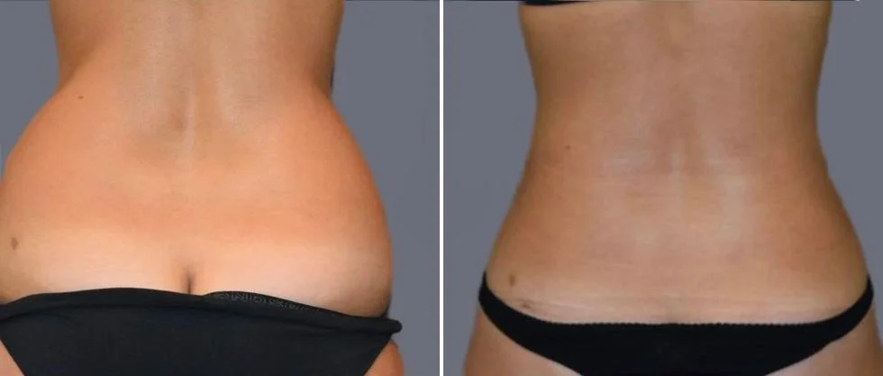 vaser back liposcution female pre2024 015 before and after before and after